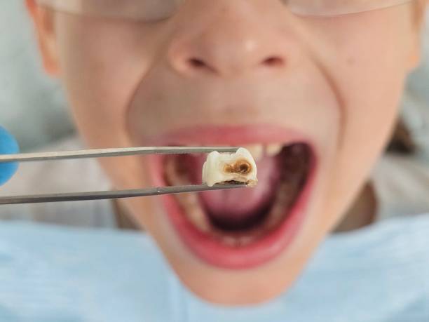 Best Emergency Tooth Extraction in River Road, NC